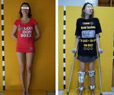 为成为183公分模特儿,俄罗斯30岁女勇敢接受断腿增高手术.